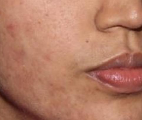 Acne After (3)