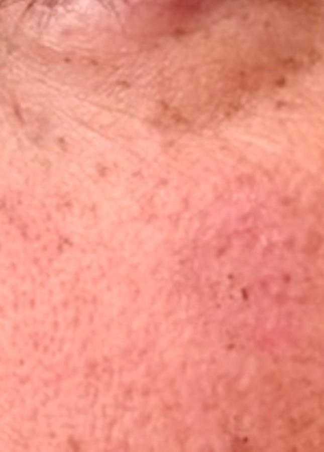 Melasma After (2)