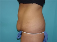 Dr. Serra Surgical Before & After