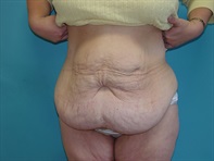 Dr. Serra Surgical Before & After